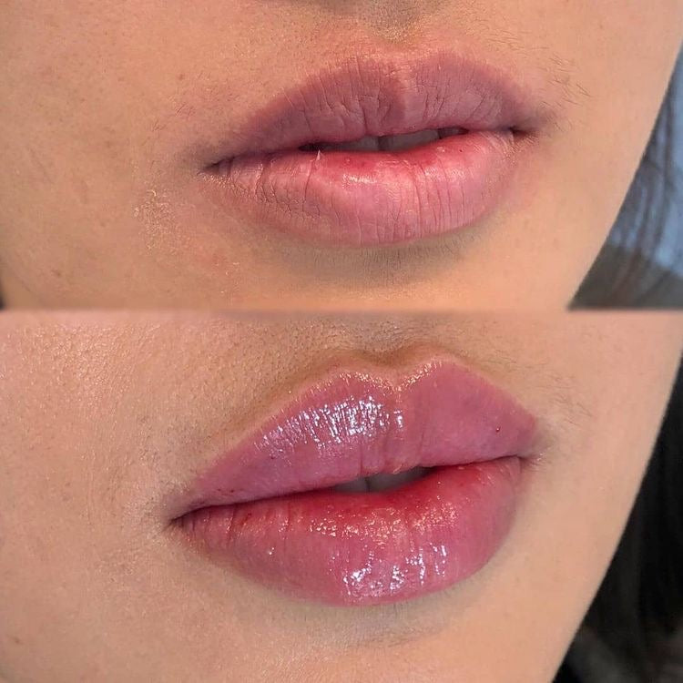 Voluminizador de labios